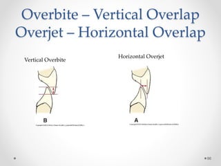 Overbite – Vertical Overlap 
Overjet – Horizontal Overlap 
86 
Vertical Overbite 
Horizontal Overjet 
 