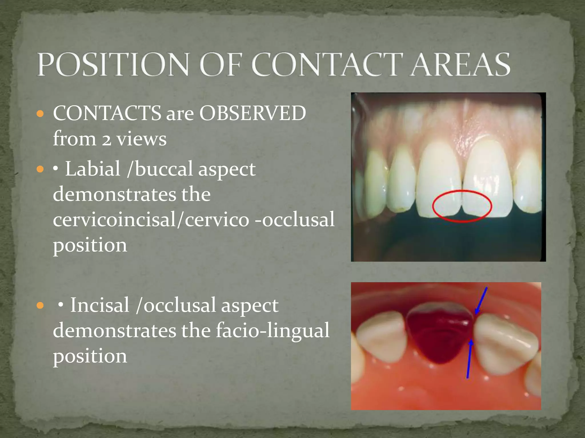  CONTACTS are OBSERVED
from 2 views
 • Labial /buccal aspect
demonstrates the
cervicoincisal/cervico -occlusal
position
 • Incisal /occlusal aspect
demonstrates the facio-lingual
position
 