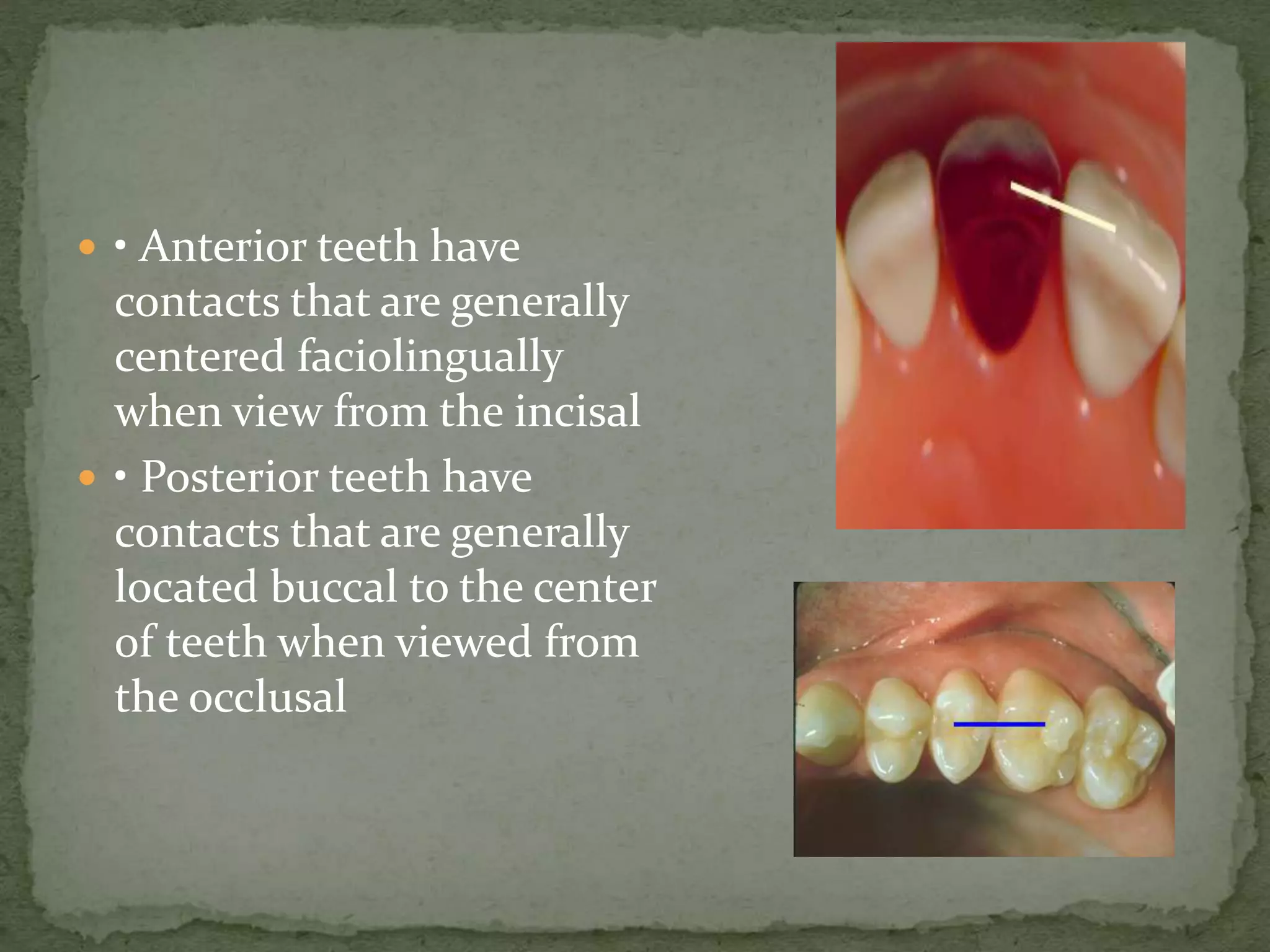 • Anterior teeth have
contacts that are generally
centered faciolingually
when view from the incisal
 • Posterior teeth have
contacts that are generally
located buccal to the center
of teeth when viewed from
the occlusal
 