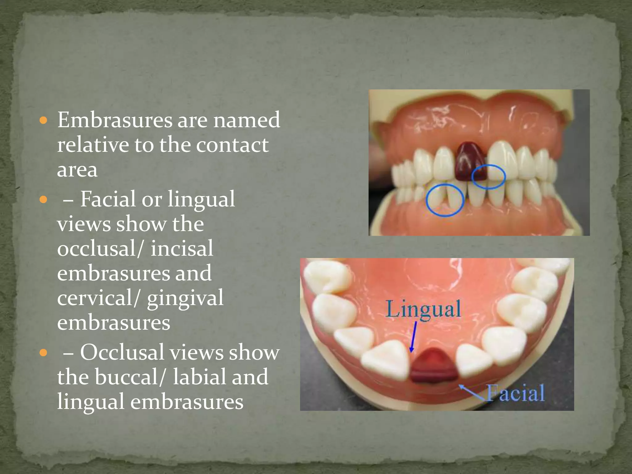  Embrasures are named
relative to the contact
area
 – Facial or lingual
views show the
occlusal/ incisal
embrasures and
cervical/ gingival
embrasures
 – Occlusal views show
the buccal/ labial and
lingual embrasures
 