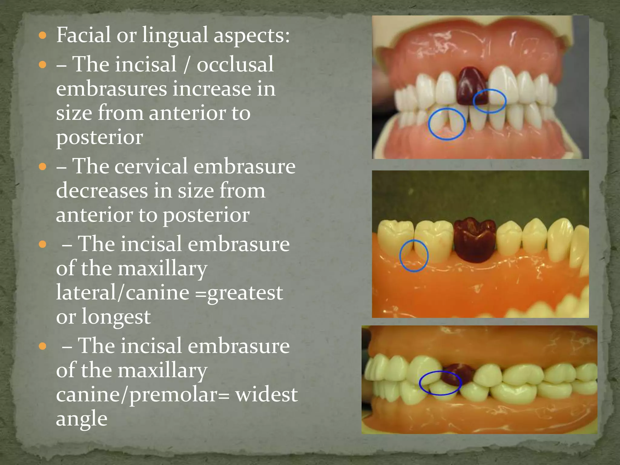  Facial or lingual aspects:
 – The incisal / occlusal
embrasures increase in
size from anterior to
posterior
 – The cervical embrasure
decreases in size from
anterior to posterior
 – The incisal embrasure
of the maxillary
lateral/canine =greatest
or longest
 – The incisal embrasure
of the maxillary
canine/premolar= widest
angle
 