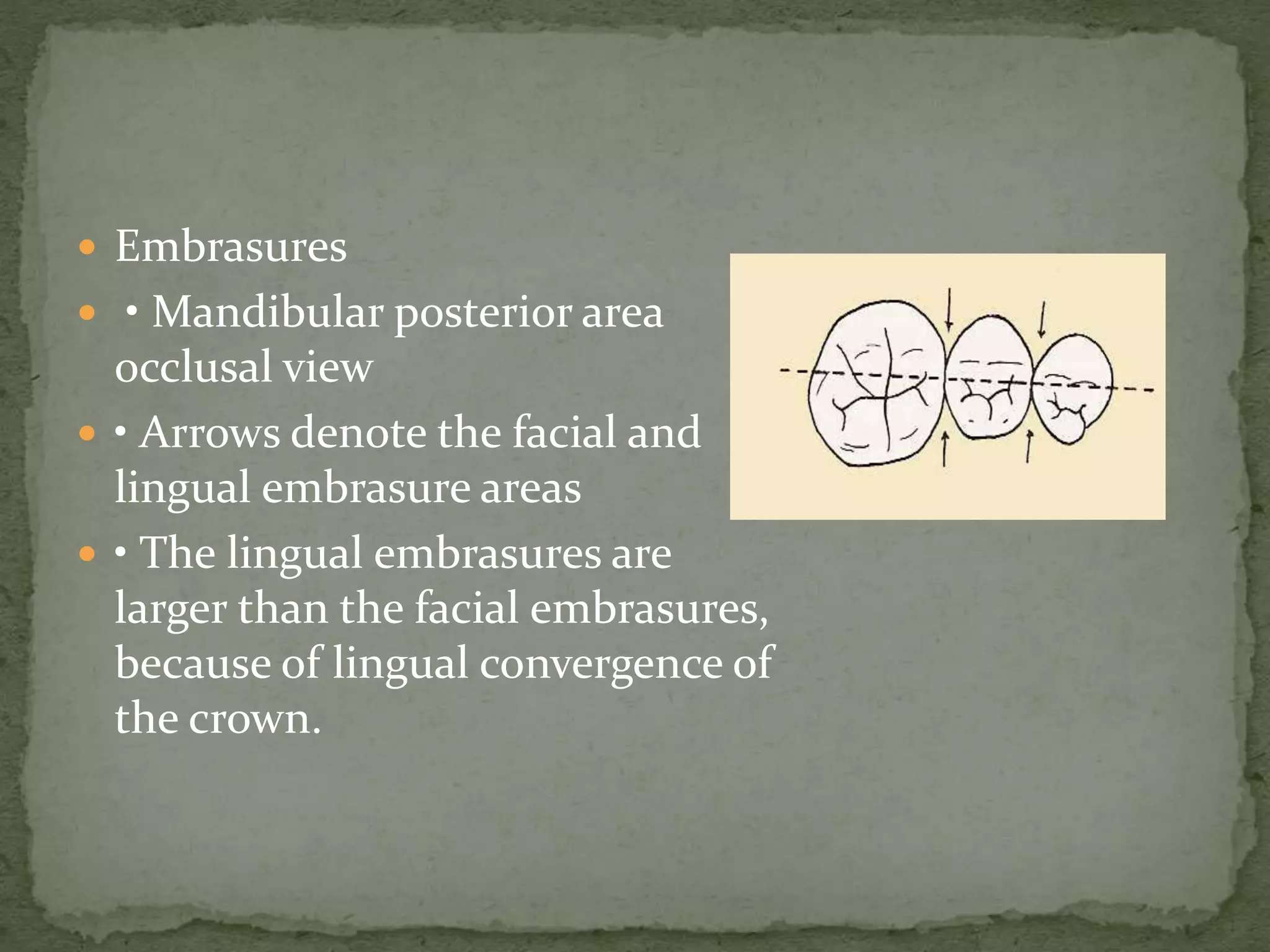  Embrasures
 • Mandibular posterior area
occlusal view
 • Arrows denote the facial and
lingual embrasure areas
 • The lingual embrasures are
larger than the facial embrasures,
because of lingual convergence of
the crown.
 