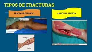 TIPOS DE FRACTURAS
FRACTURA ABIERTAFRACTURA CERRADA
 