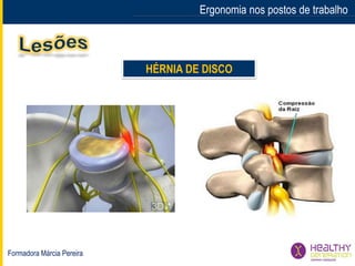 Formadora Márcia Pereira
Ergonomia nos postos de trabalho
HÉRNIA DE DISCO
 