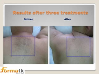 Results after three treatments
Before

After

 