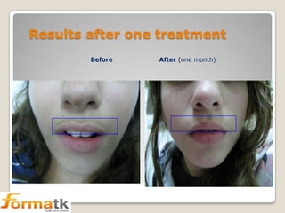 Results after one treatment
Before

After (one month)

 