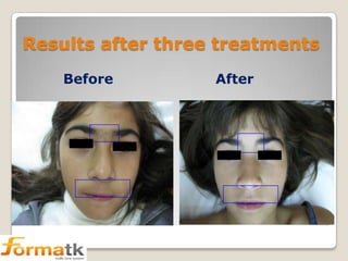 Results after three treatments
Before

After

 
