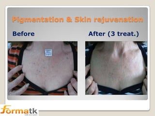 Pigmentation & Skin rejuvenation
Before

After (3 treat.)

 