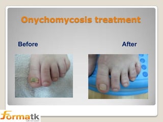 Onychomycosis treatment
Before

After

 