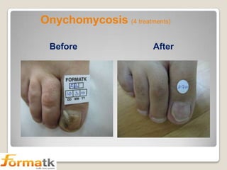 Onychomycosis (4 treatments)
Before

After

 