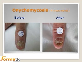 Onychomycosis
Before

(4 treatments)

After

 