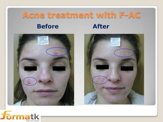 Acne treatment with F-AC
Before

After

 