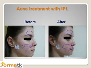 Acne treatment with IPL
Before

After

 