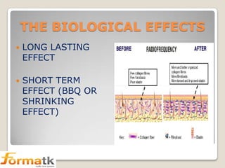 THE BIOLOGICAL EFFECTS


LONG LASTING
EFFECT



SHORT TERM
EFFECT (BBQ OR
SHRINKING
EFFECT)

 