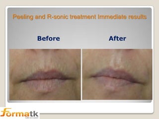 Peeling and R-sonic treatment Immediate results

Before

After

 