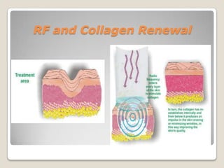 RF and Collagen Renewal

 