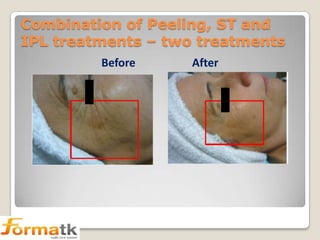 Combination of Peeling, ST and
IPL treatments – two treatments
Before

After

 