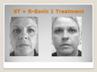 ST + R-Sonic 1 Treatment

 