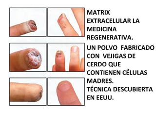 MATRIX
EXTRACELULAR LA
MEDICINA
REGENERATIVA.
UN POLVO FABRICADO
CON VEJIGAS DE
CERDO QUE
CONTIENEN CÉLULAS
MADRES.
TÉCNICA DESCUBIERTA
EN EEUU.