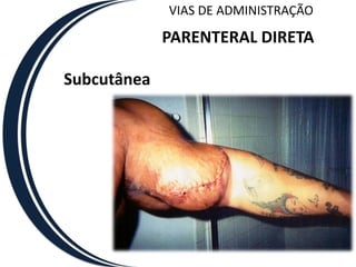 VIAS DE ADMINISTRAÇÃO

             PARENTERAL DIRETA

Subcutânea
 