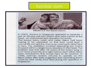 Kembar siam
 