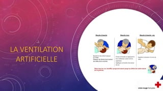 LA VENTILATION
ARTIFICIELLE
 