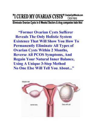 “Former Ovarian Cysts Sufferer
 Reveals The Only Holistic System
Existence That Will Show You How To
Permanently Eliminate All Types of
Ovarian Cysts Within 2 Months,
Reverse All PCOS Symptoms, And
Regain Your Natural Inner Balance,
Using A Unique 3-Step Method
No One Else Will Tell You About...”
 
