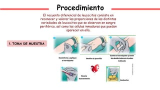 Procedimiento
1. TOMA DE MUESTRA
El recuento diferencial de leucocitos consiste en
reconocer y valorar las proporciones de las distintas
variedades de leucocitos que se observan en sangre
periférica, así como las células inmaduras que puedan
aparecer en ella.
 