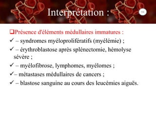 Interprétation :
Présence d'éléments médullaires immatures :
 – syndromes myéloprolifératifs (myélémie) ;
 – érythroblastose après splénectomie, hémolyse
sévère ;
 – myélofibrose, lymphomes, myélomes ;
– métastases médullaires de cancers ;
 – blastose sanguine au cours des leucémies aiguës.
 