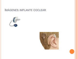 IMÁGENES IMPLANTE COCLEAR
 