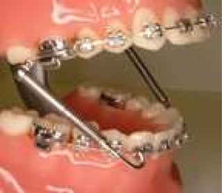 Glauser Williams Orthodontics - Forsus Springs