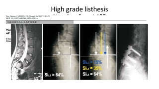 High grade listhesis
Need to fuse L4??
 