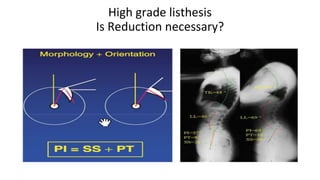 High grade listhesis
Is Reduction necessary?
 