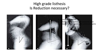 High grade listhesis
Is Reduction necessary?
A- Balanced Sacropelvis
B- Unbalanced Sacropelvis with balanced Spine
C- Unbalanced Sacropelvis with unbalanced spine
 