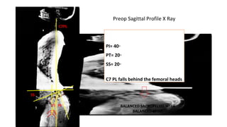 PI= 40◦
PT= 20◦
SS= 20◦
C7 PL falls behind the femoral heads
SS
PIPT
C7PL
BALANCED SACROPELVIS WITH
BALANCED SPINE
Preop Sagittal Profile X Ray
 