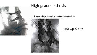 High grade listhesis
In Situ Fusion with posterior instrumentation
Post Op X Ray
 