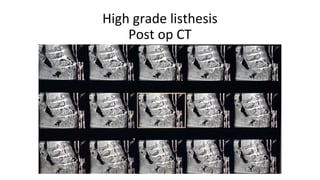 High grade listhesis
Post op CT
 