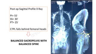 Post op Sagittal Profile X Ray
PI= 55◦
SS= 30◦
PT= 25◦
C7PL falls behind femoral heads
BALANCED SACROPELVIS WITH
BALANCED SPINE
 