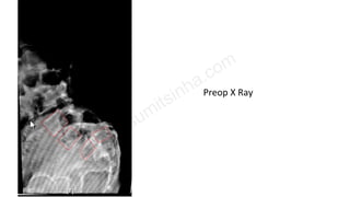 Preop X Ray
 