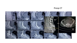 Preop CT
 