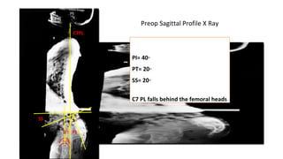PI= 40◦
PT= 20◦
SS= 20◦
C7 PL falls behind the femoral heads
SS
PIPT
C7PL
Preop Sagittal Profile X Ray
 