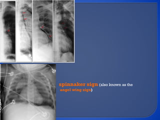 Spinacker Sign tuberculosis viral infections mediastinum radiology | PPTX
