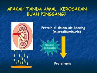 APAKAH TANDA AWAL  KEROSAKAN  BUAH PINGGANG?   Protein di dalam air kencing (microalbuminuria) Proteinuria Kencing berkeladak 