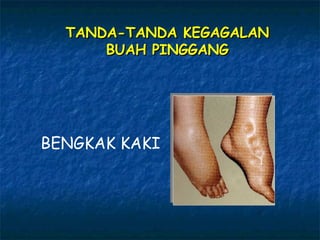BENGKAK KAKI TANDA-TANDA KEGAGALAN  BUAH PINGGANG  