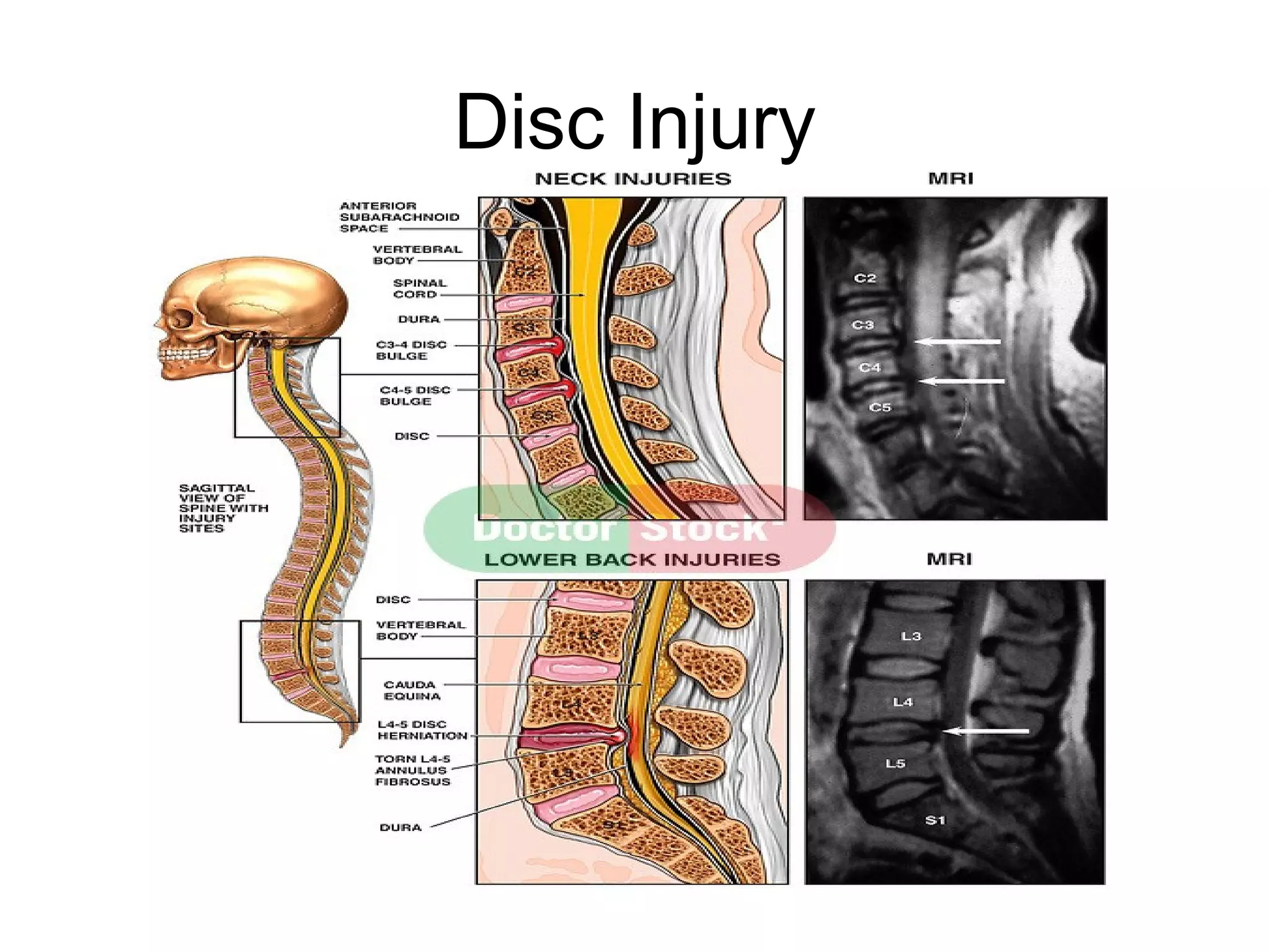 Disc Injury
 