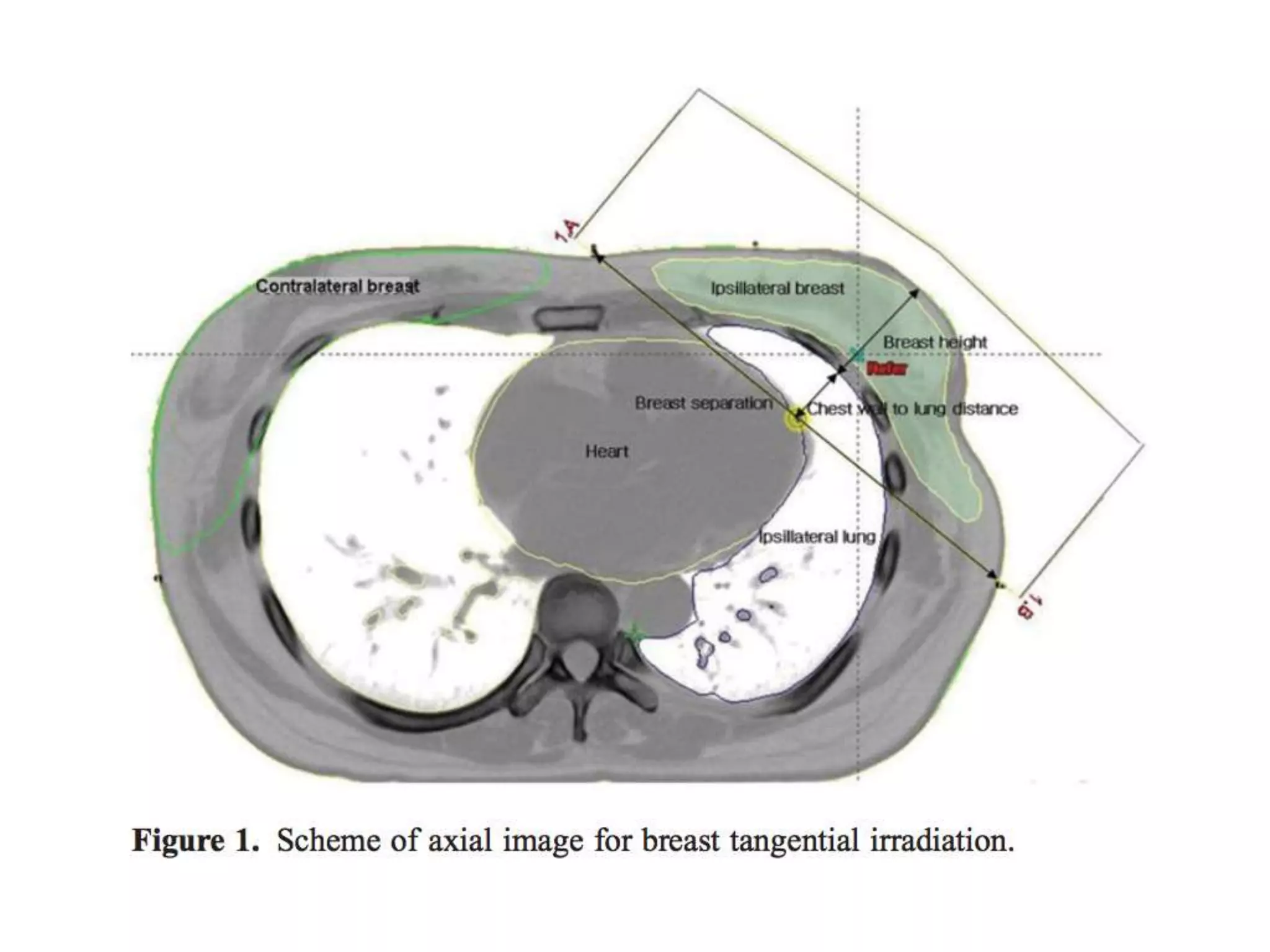Forward imrt in breast radiotherapy | PPTX