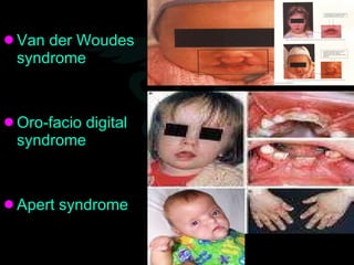 <ul><li>Van der Woudes syndrome </li></ul><ul><li>Oro-facio digital syndrome </li></ul><ul><li>Apert syndrome </li></ul>