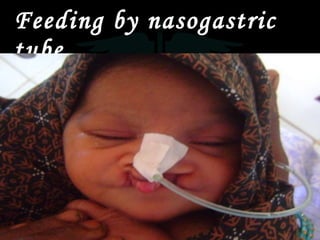 Feeding by nasogastric tube 