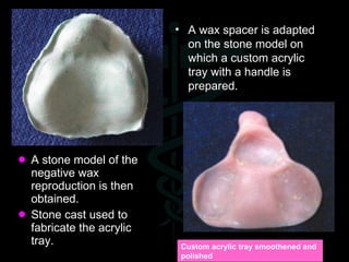 <ul><li>A stone model of the negative wax reproduction is then obtained. </li></ul><ul><li>Stone cast used to fabricate th...