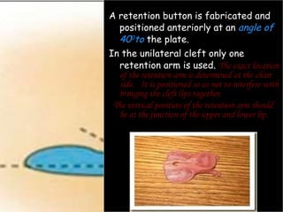 <ul><li>A retention button is fabricated and positioned anteriorly at an  angle of 40 0 to  the plate.  </li></ul><ul><li>...